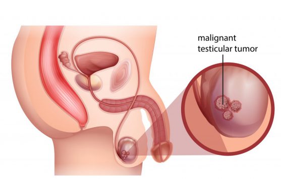 Testicular Cancer